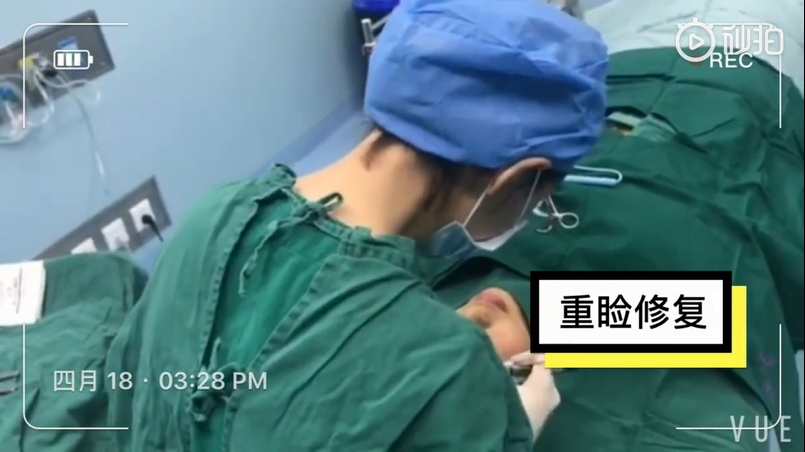 上海美萊雙眼皮手術過程