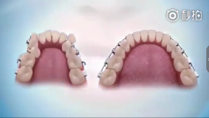 牙齒矯正的過程是什么樣的？讓蘇州美萊告訴你