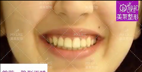 天津美萊牙齒矯正全過程真人案例