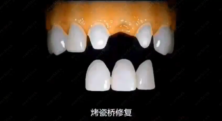 蘇州美萊牙齒修復方法
