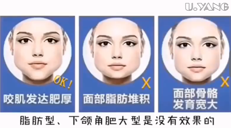 南京美萊瘦臉全過程圖