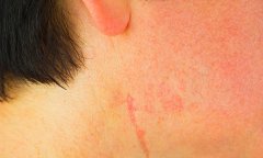 激光治療疤痕多久能恢復正常膚色，一次需要多少錢