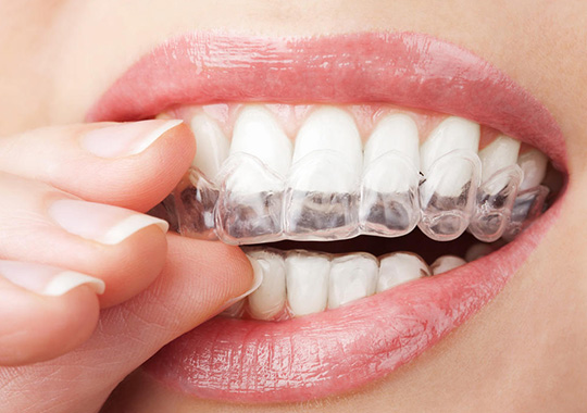 成都牙齒矯正哪家口腔醫院比較好，矯正牙齒一般要花多少時間