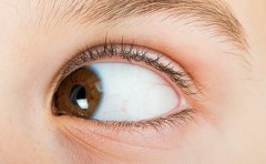 雙眼皮手術多久能恢復自然,飲食禁忌有哪些